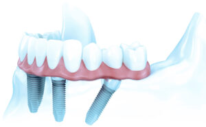 FES Implants 1