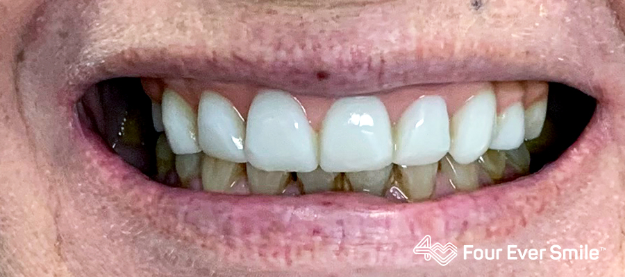 after, four ever smile, real, white, permanent teeth