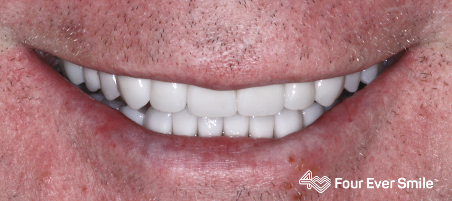 four ever smile, after, permanent teeth, zirconia