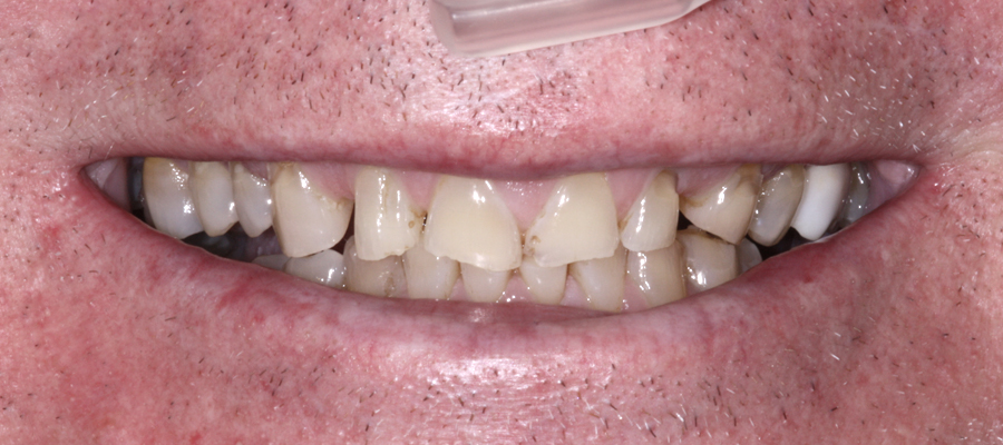 all on four before, after, four ever smile, long island, teeth